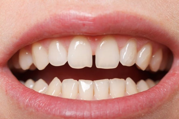 Lücke zwischen den Schneidezähnen: Diastema und Möglichkeiten