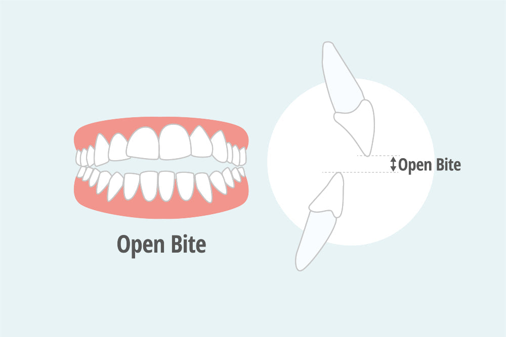 Open bite: possible causes, assessment and treatments
