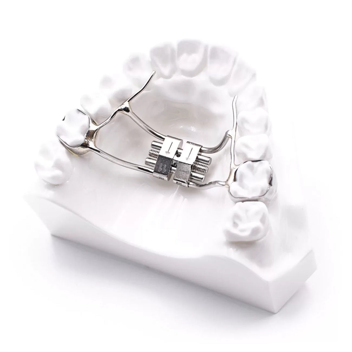 Palatal expansion: indications, appliances and treatment stages