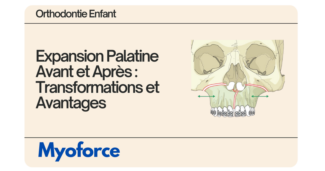 expansion-palatine-avant-apres