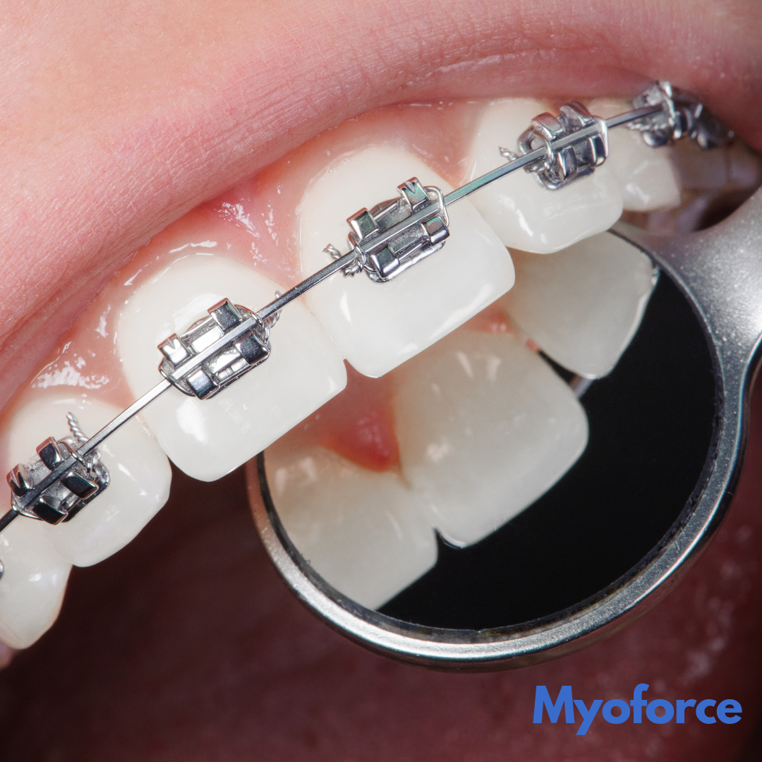 Children's orthodontic costs in France: quotes and reimbursement in 2026